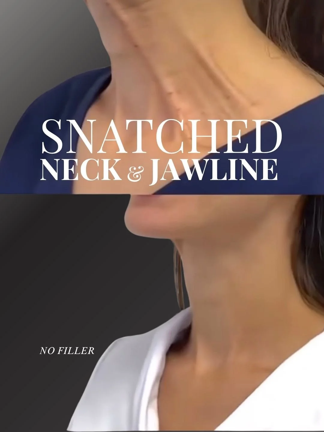 Before and after images showing a woman's neck and jawline, highlighting a snatched look with no filler.