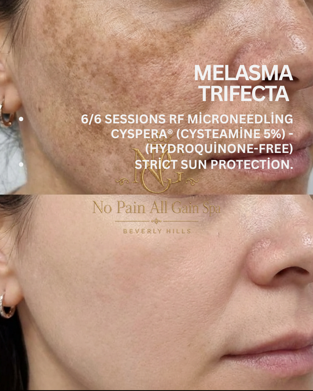 Before and after images of a person's cheek showing the effects of a skin treatment for melasma trificta, with text overlay describing the procedure and sun protection advice.