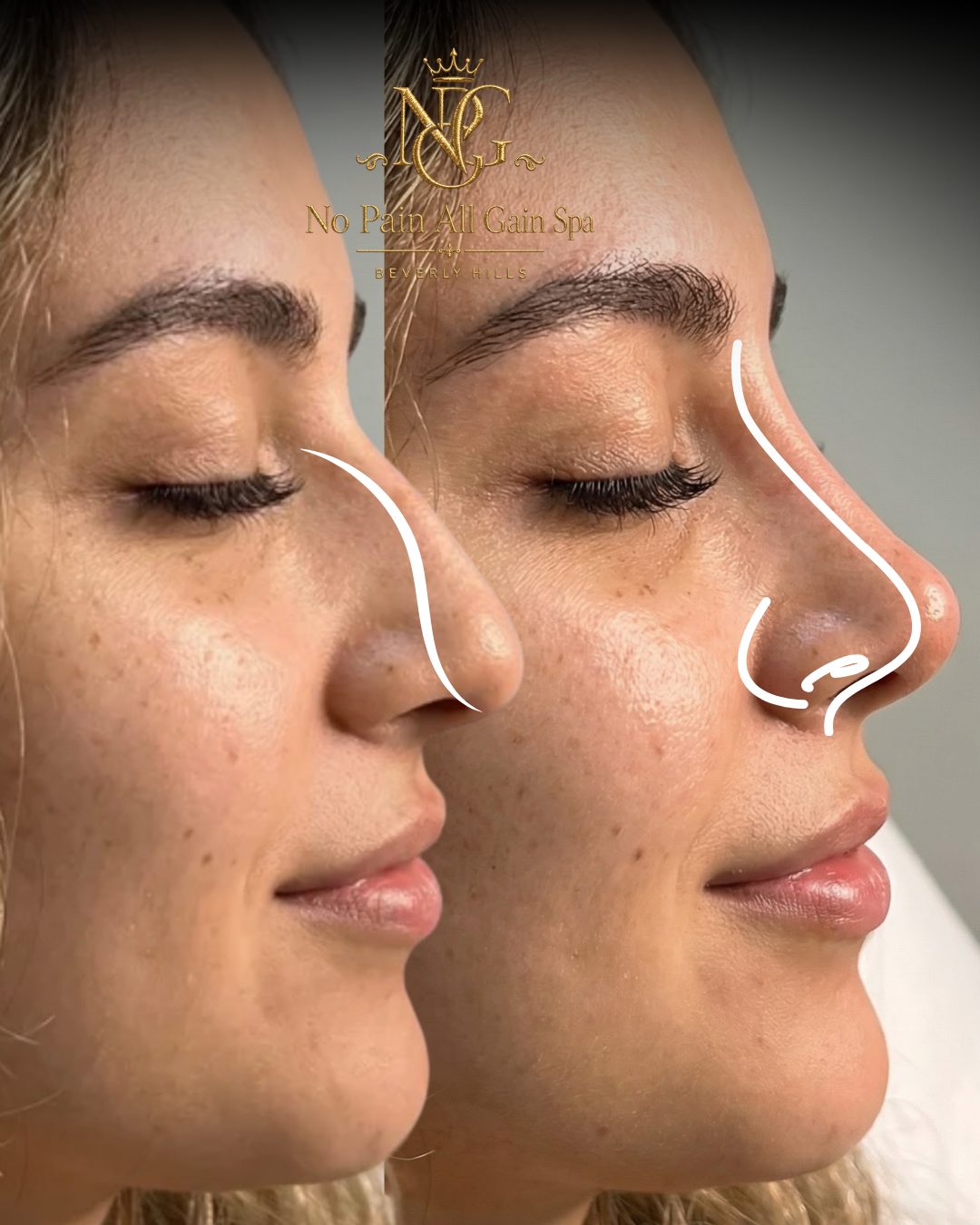 Before and after comparison of a woman's profile, highlighting a nose transformation procedure, with the spa's logo and name 'No Pain All Gain Spa Beverly Hills' at the top.