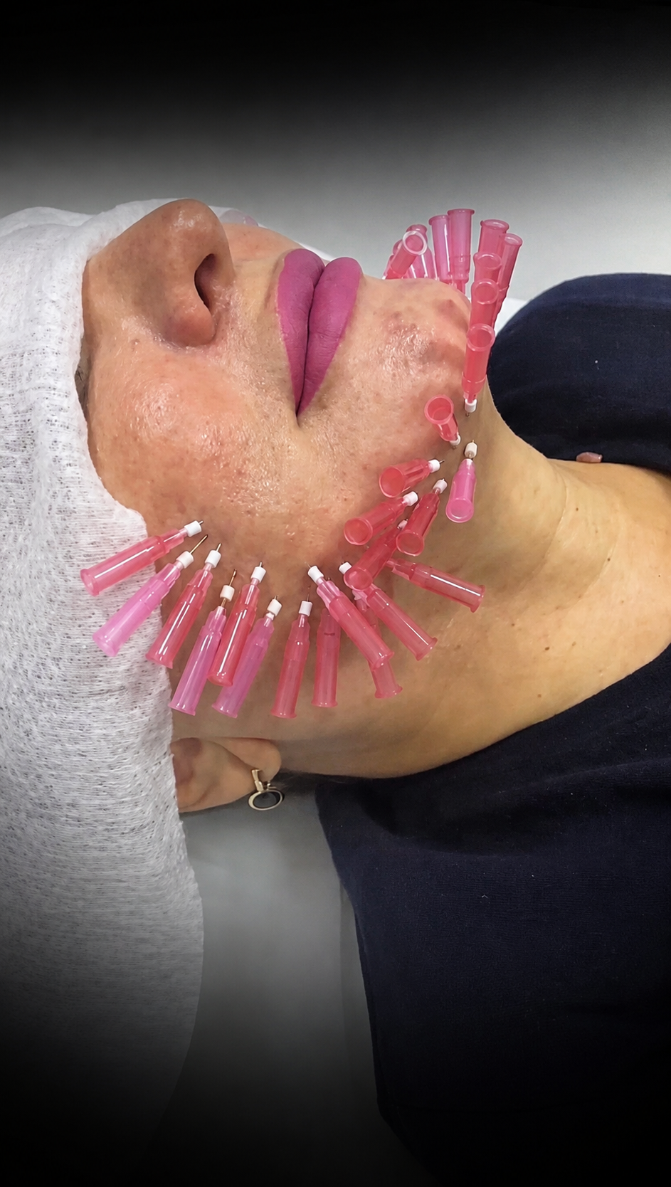 A person receiving facial acupuncture with multiple pink acupuncture needles inserted into their face and neck.