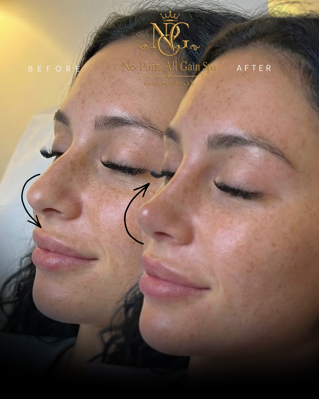 Comparison photo showing a woman's face before and after a skin treatment at No Pain All Gain Spa in Beverly Hills, highlighting improved skin texture and tone.
