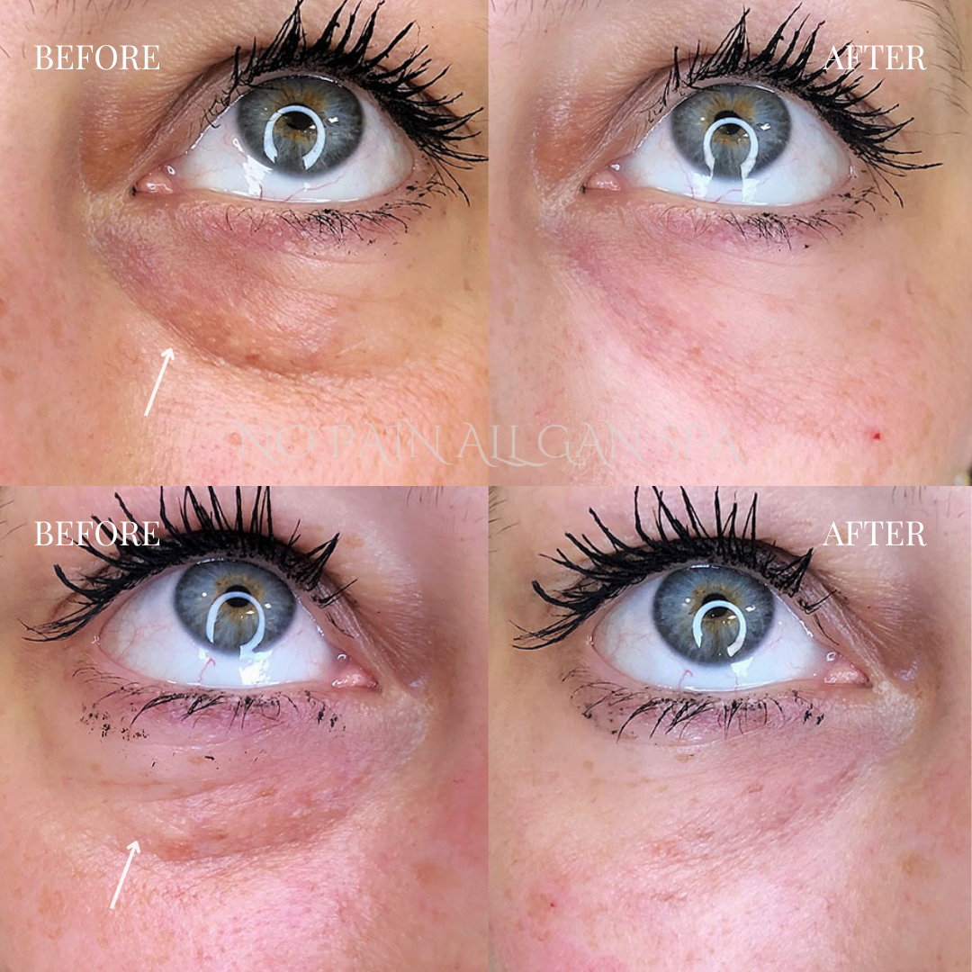 Close-up of a woman's eye before and after under-eye treatment, showing reduced puffiness and fine lines.