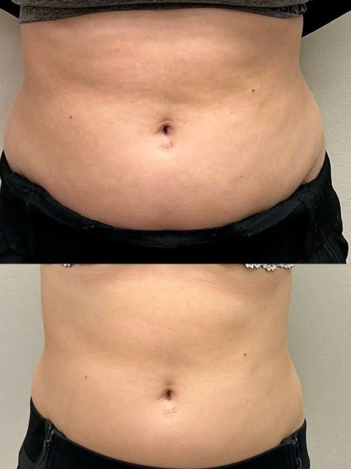 A comparison of a person's abdominal area before and after weight loss or body contouring, showing a reduction in belly fat and a more defined waistline.