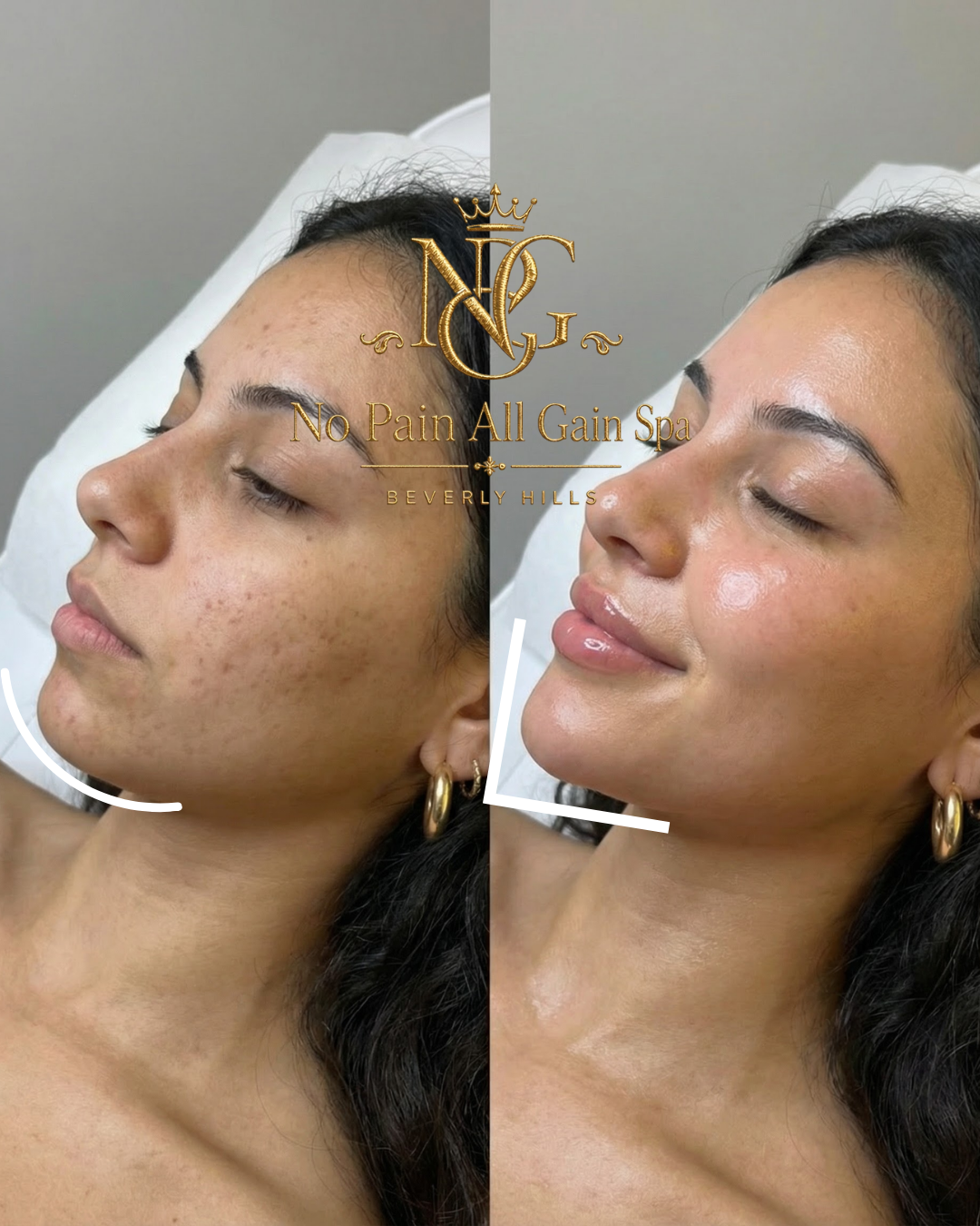 Side-by-side comparison of a woman's face before and after a skincare treatment, showing improvement in skin texture and appearance, with the logo and text overlay for 'No Pain All Gain Spa Beverly Hills'.