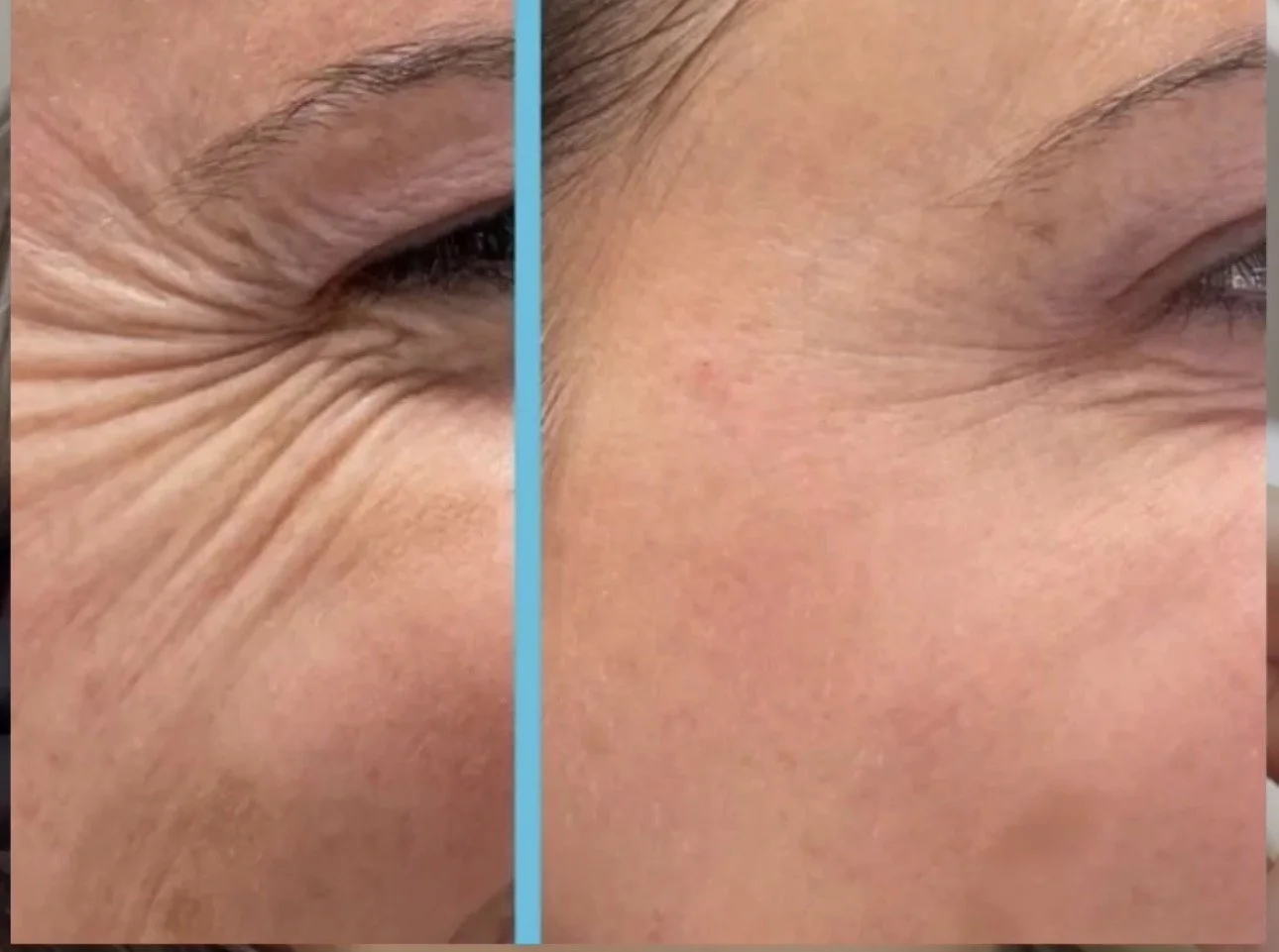 Comparison image showing a close-up of a person's eye area with wrinkles on the left and smooth skin on the right.
