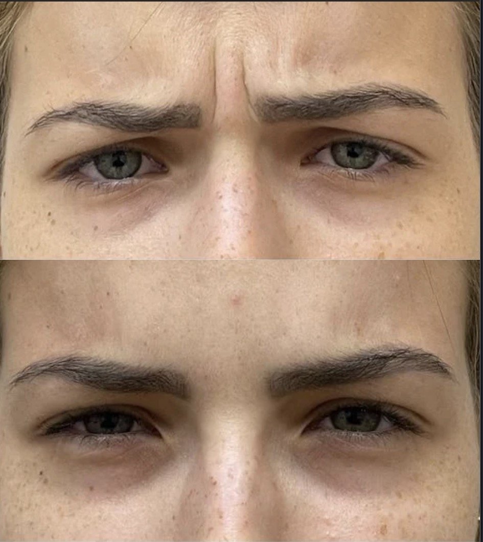Close-up of a person's face showing a before-and-after comparison of eyebrow makeup or grooming.