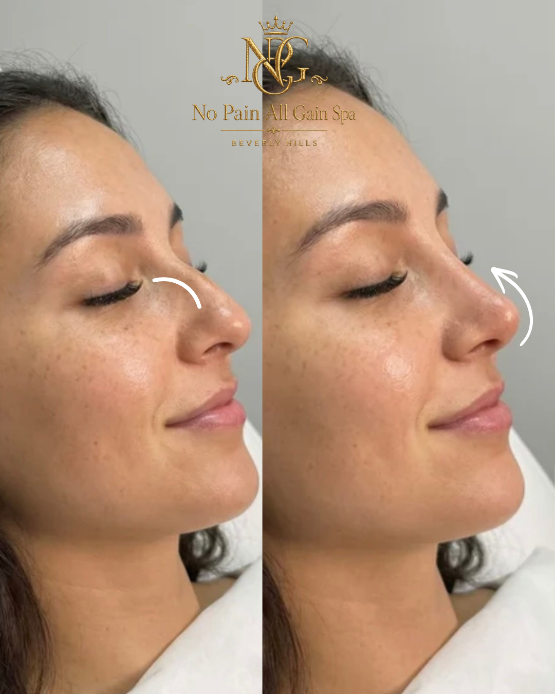 Comparison of a woman's nose before and after a cosmetic procedure, showing slight nose lifting and contour improvement at a spa in Beverly Hills.