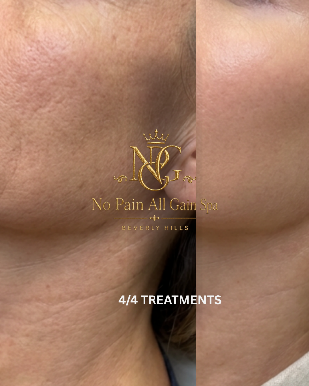 Close-up of a person's chin and jawline showing before and after effects of skin treatment at No Pain All Gain Spa in Beverly Hills, with text indicating 4 of 4 treatments completed.
