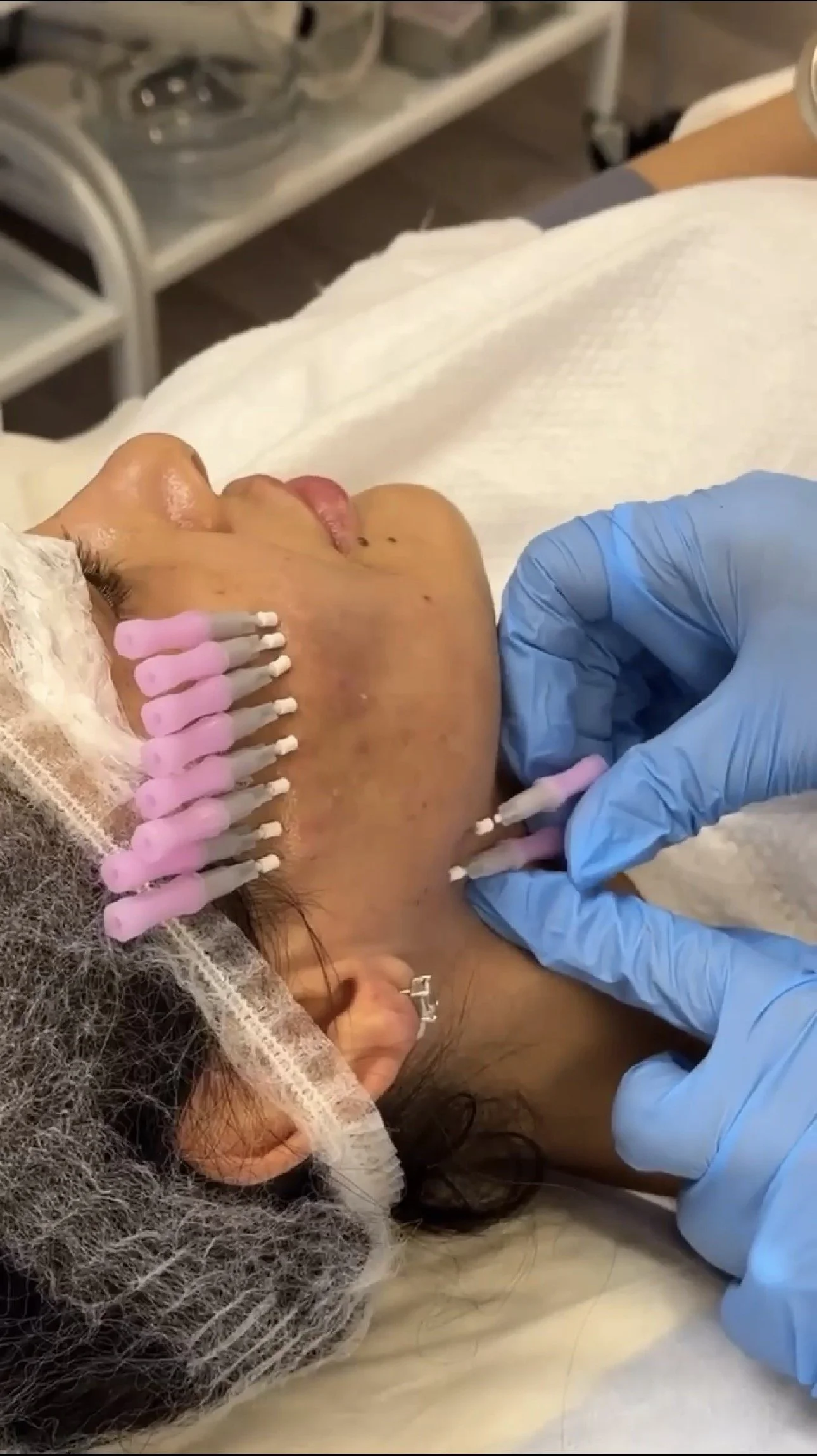 A person lying in a medical setting, having their face and neck area treated with a cosmetic procedure using multiple small white device attachments held by a technician wearing blue gloves.