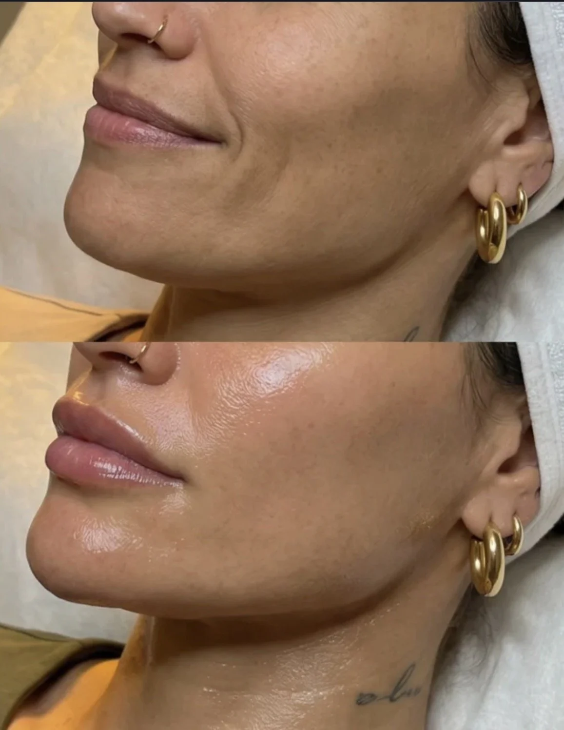SKIN TIGHTENING HIFU BEVERLY HILLS