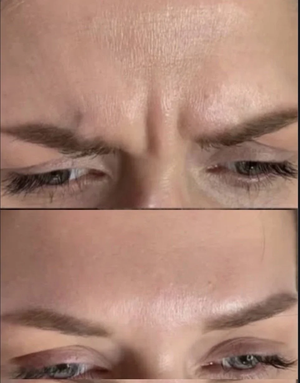 Close-up of a person's forehead and eyes, showing a before and after comparison of skincare or makeup application.