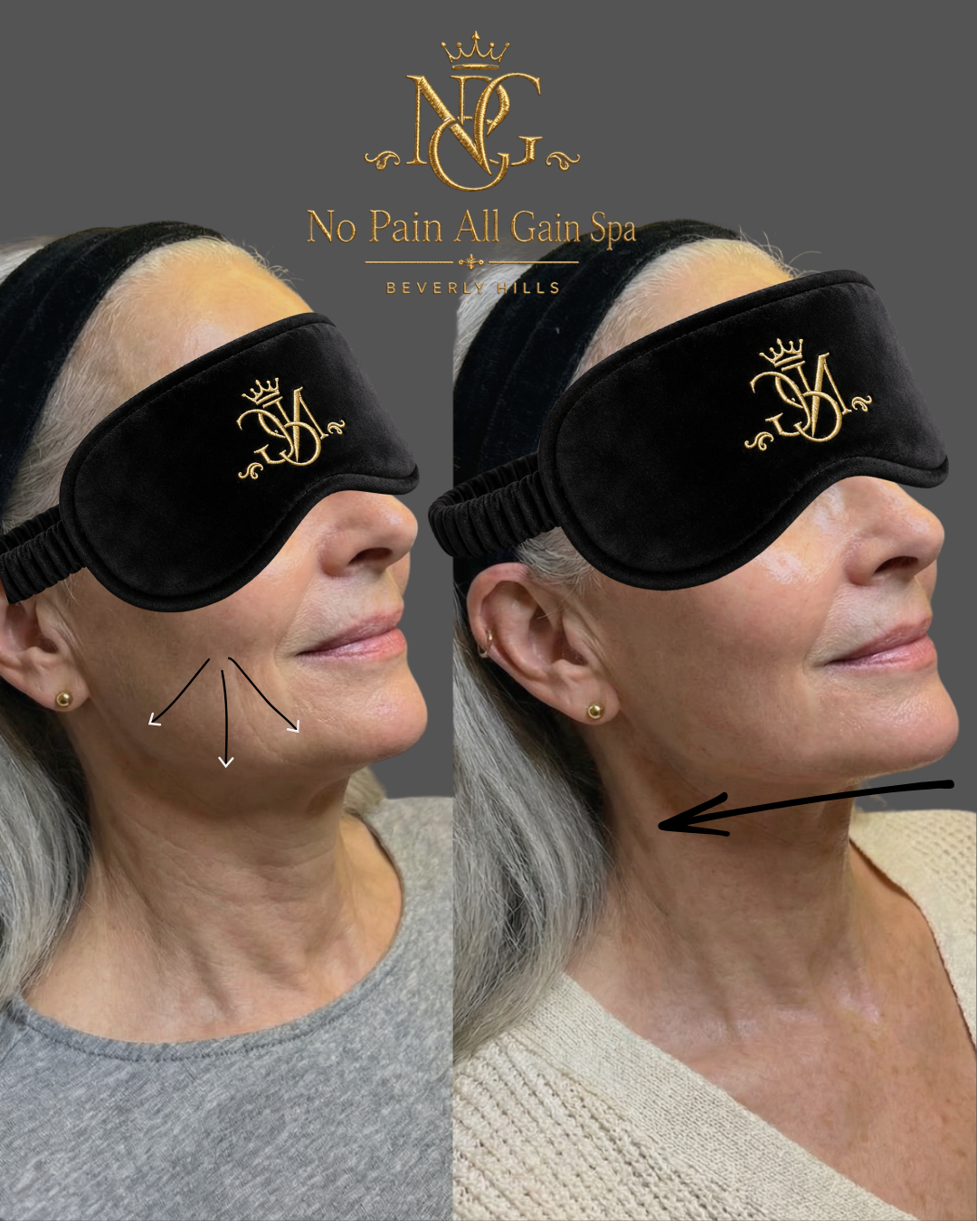 Comparison of a woman's face before and after a cosmetic treatment, with the woman wearing a black sleep mask in both images, over her eyes. The left side shows signs of aging with wrinkles, while the right side shows a smoother, rejuvenated appearan