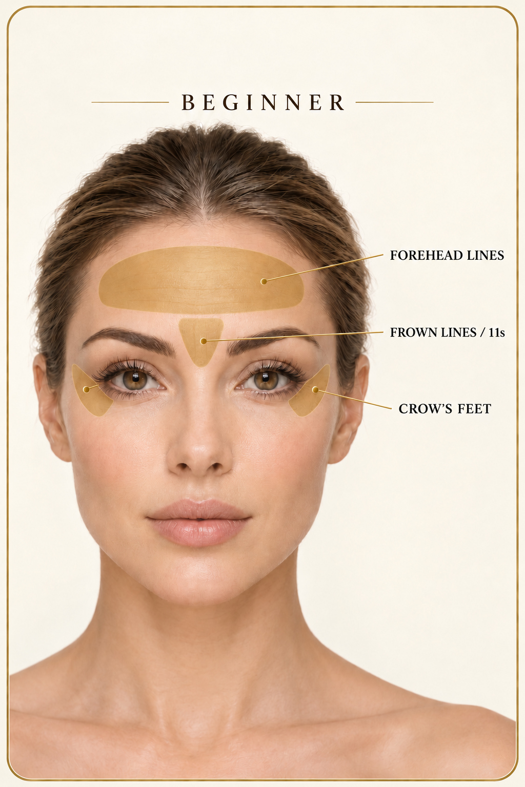 Beginner Botox treatment areas: forehead lines, frown lines between the eyebrows, and crow’s feet.