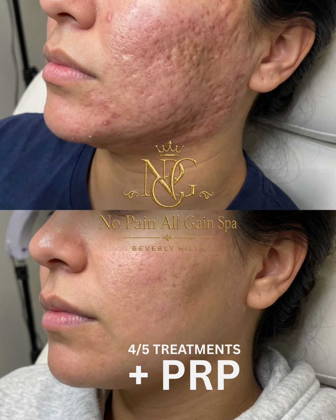 Before and after images of a woman's face showing significant reduction in acne scars and skin roughness after treatments at No Pain All Gain Spa.
