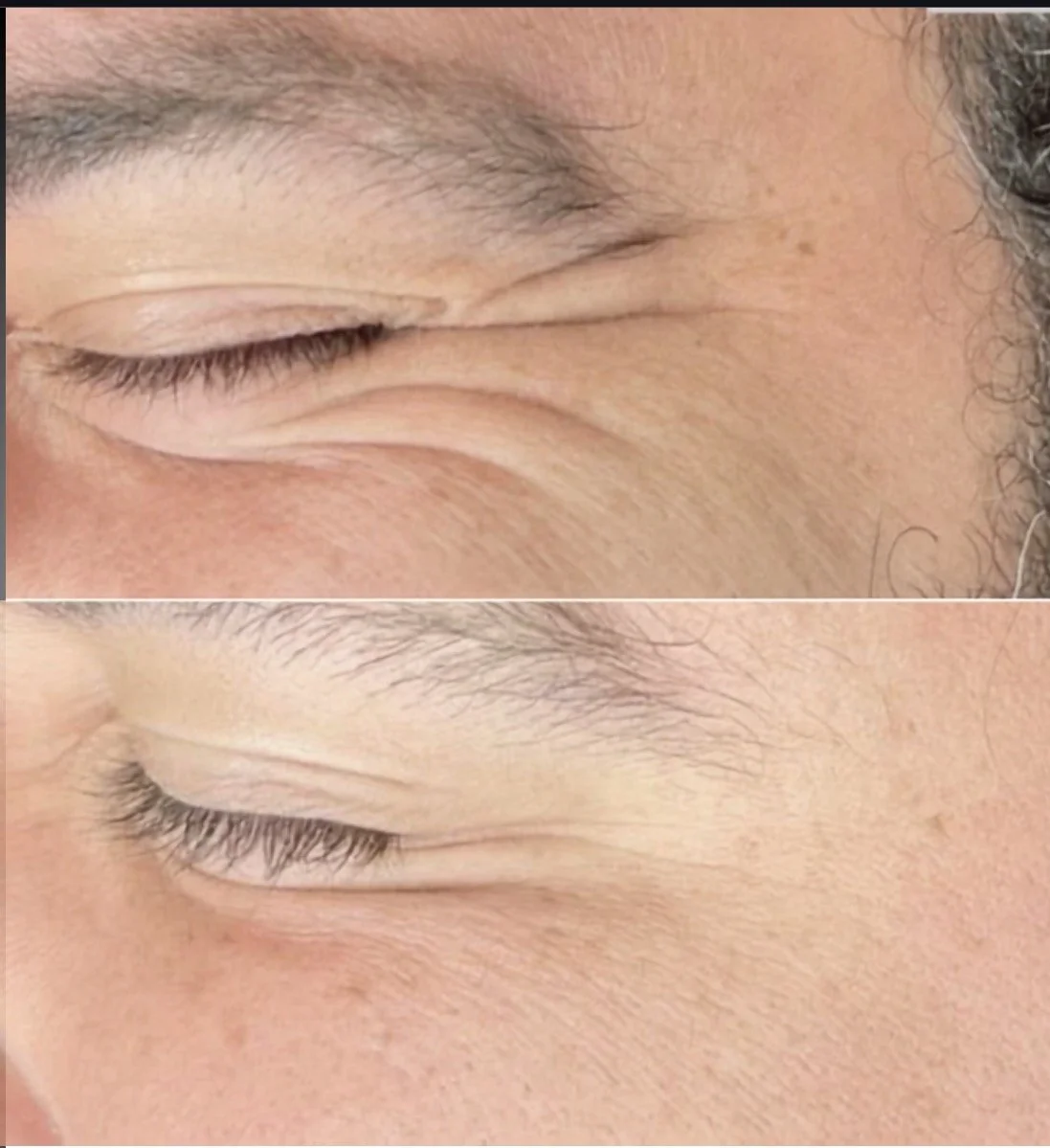 Close-up of a person's closed eyes showing slight differences in skin texture and wrinkle formation in two images, one above the other.