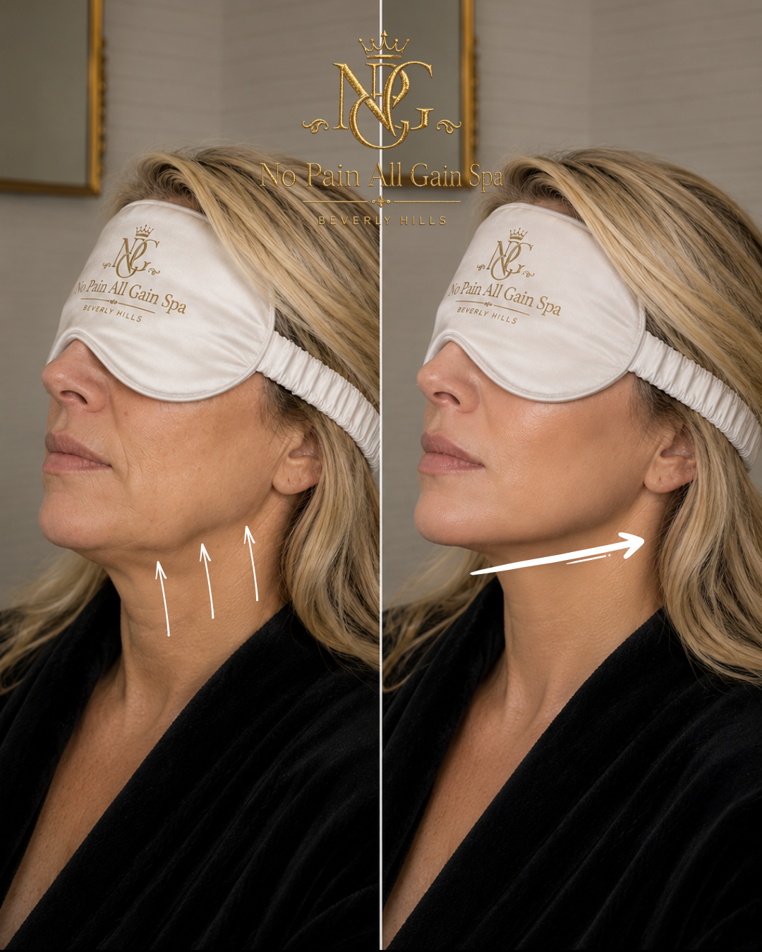 Side-by-side comparison of a woman with visible neck lifting, before and after a cosmetic procedure, lying on her back with a sleep mask at a spa.