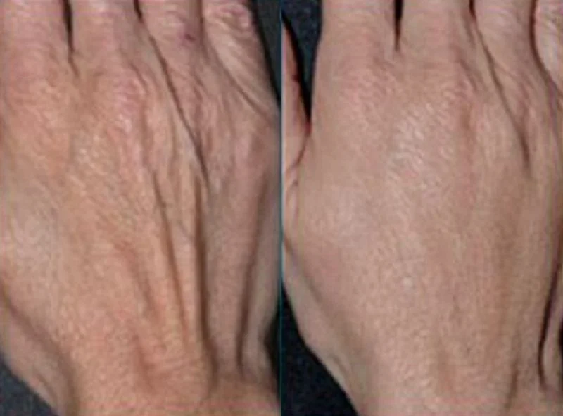 Comparison of a wrinkled skin area on the left and a smoother skin area on the right.