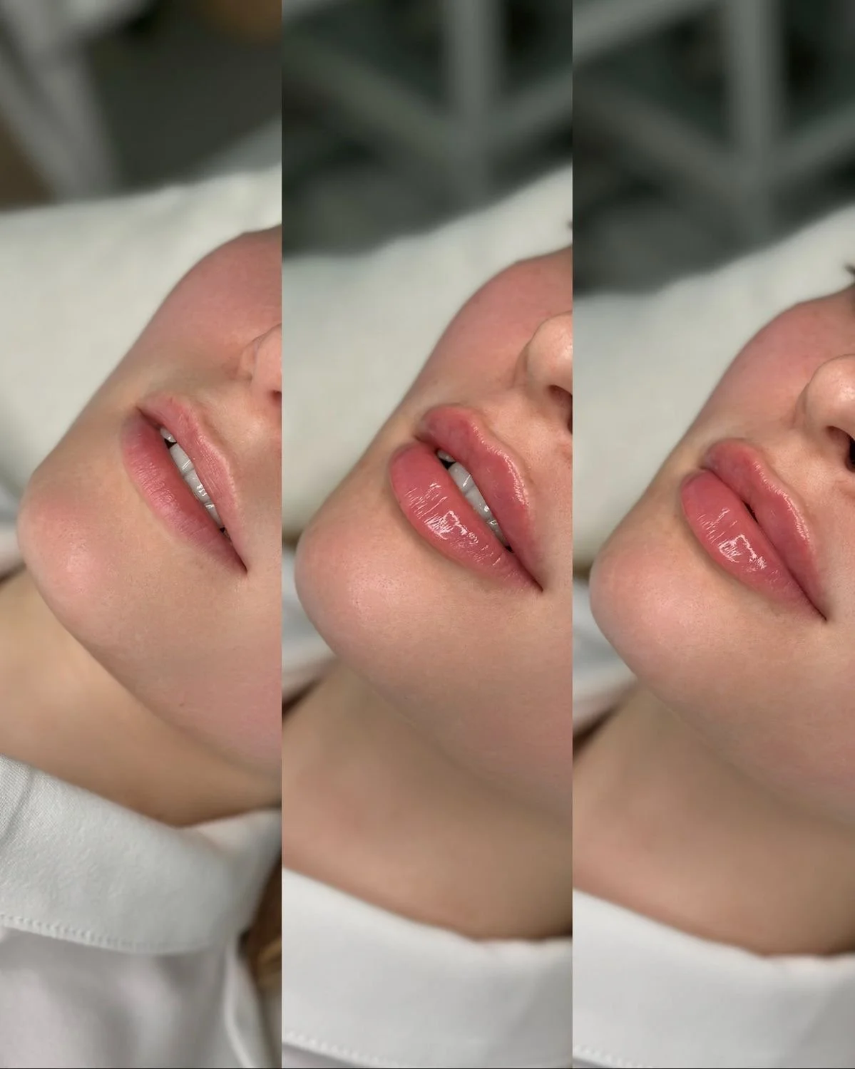 LIP FILLER BEVERLY HILLS RN 