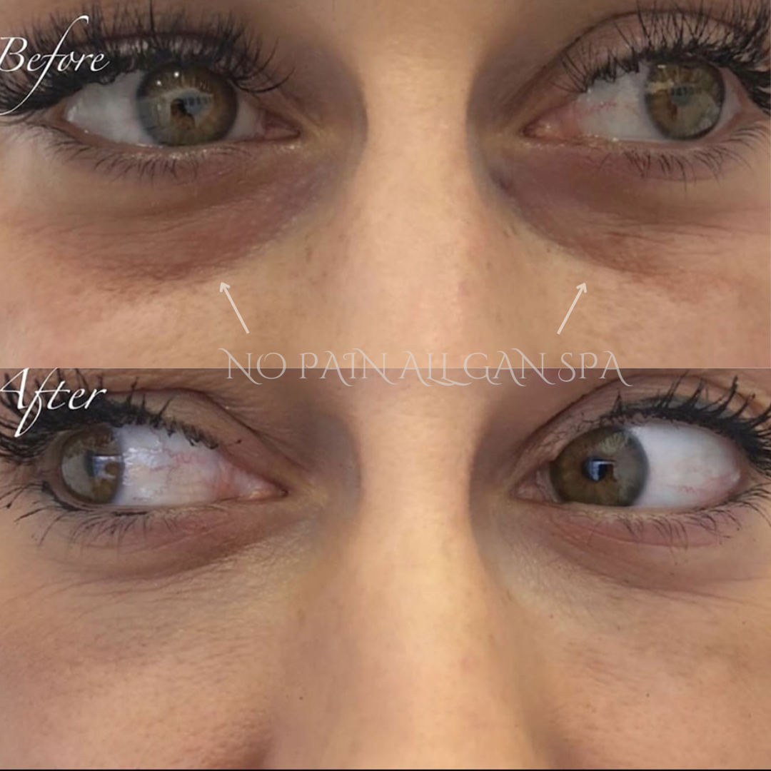 Close-up of a person's eyes before and after under-eye treatment, showing reduced dark circles and puffiness.