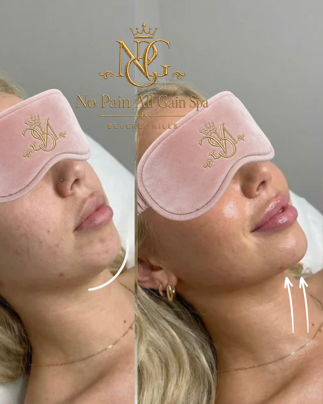 Side-by-side before and after images of a woman with a pink eye mask, showing facial skin improvement and a more lifted look in the after photo, with text promoting No Pain All Gain Spa in Beverly Hills.