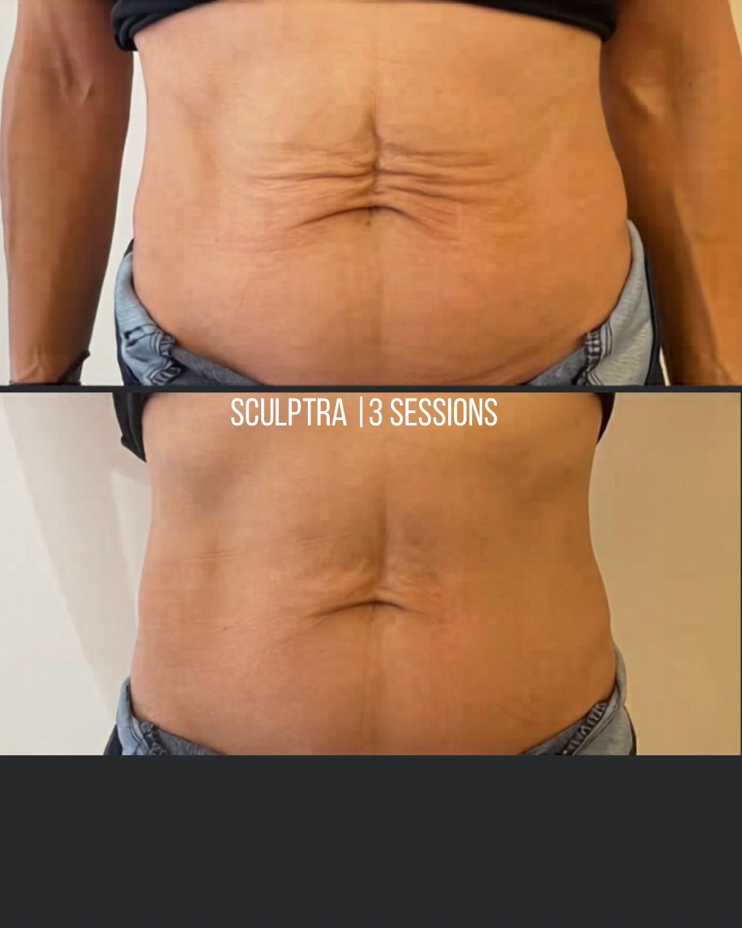 Before and after images showing the abdominal area of a person, demonstrating skin tightening and improved appearance after 13 Sculptra sessions.