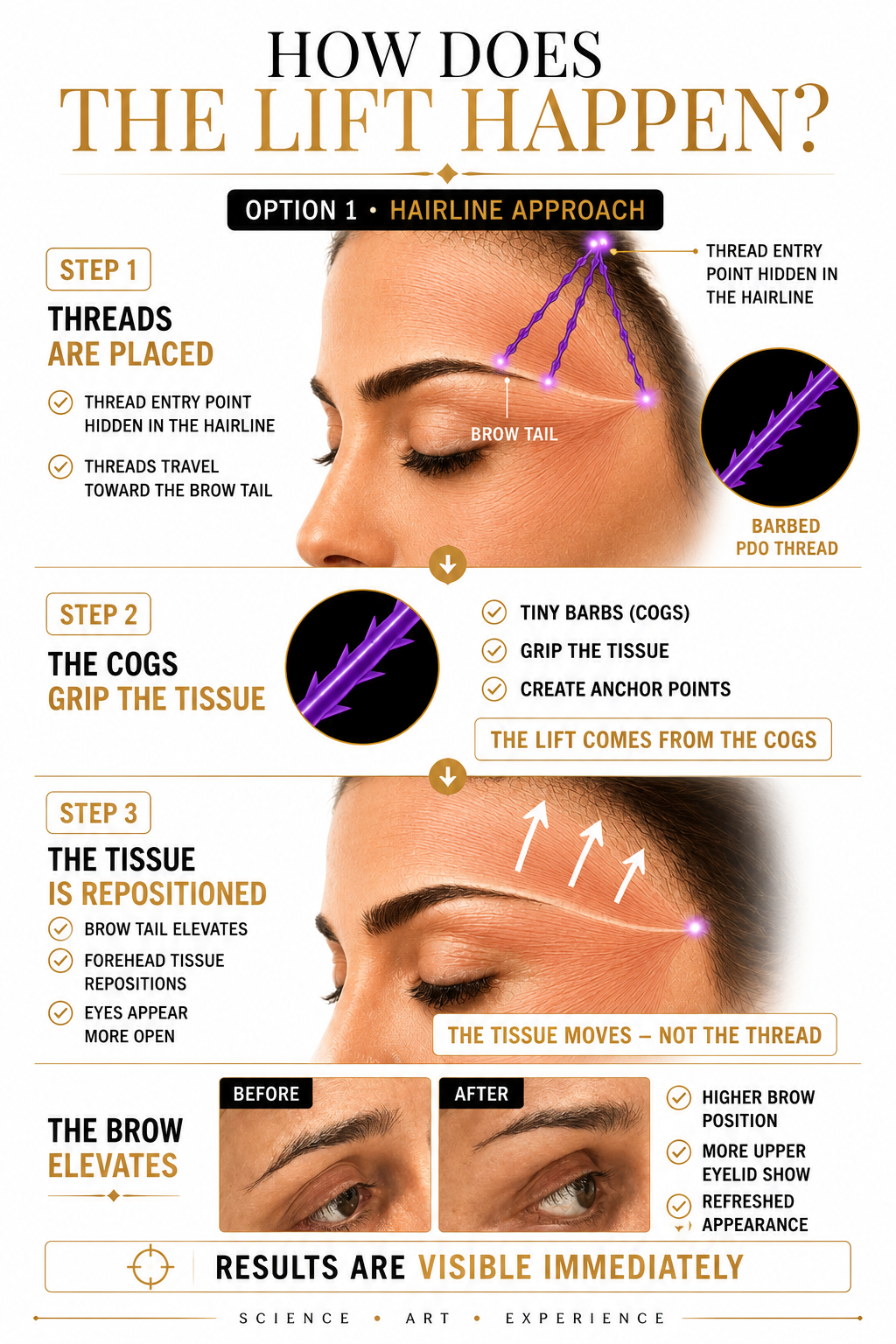 An infographic explaining how eyebrow lifting using the hairline approach works, showing steps involving threading, cogs, tissue repositioning, and resulting in higher brow position and improved appearance.