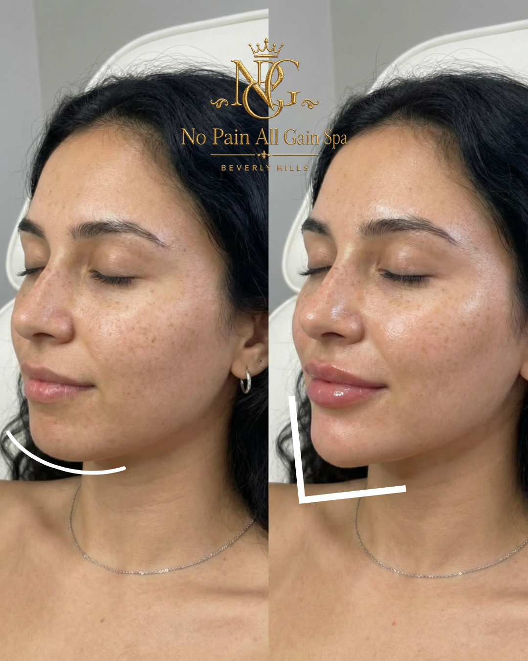 Before and after comparison of a woman's face showing skin improvement. The left side shows facial skin with freckles and blemishes, while the right side shows smoother, clearer skin with a shine and glossy lips. Text overlay indicates the image is f