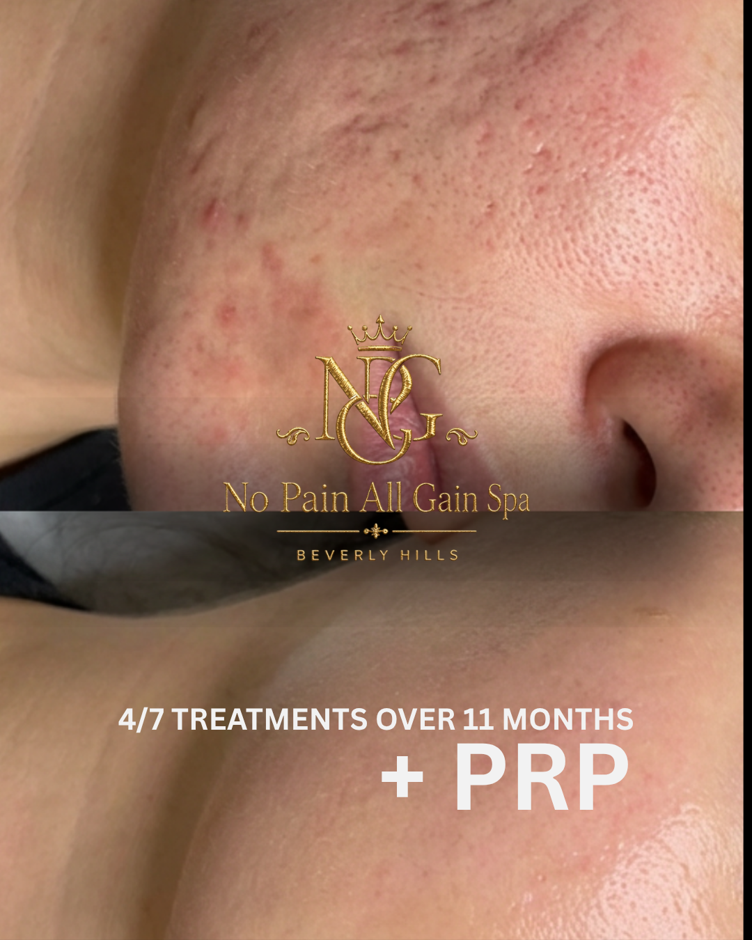 Close-up of a person's skin showing acne scars on the cheek and nose with overlaid text and logo promoting a spa treatment for skin healing.