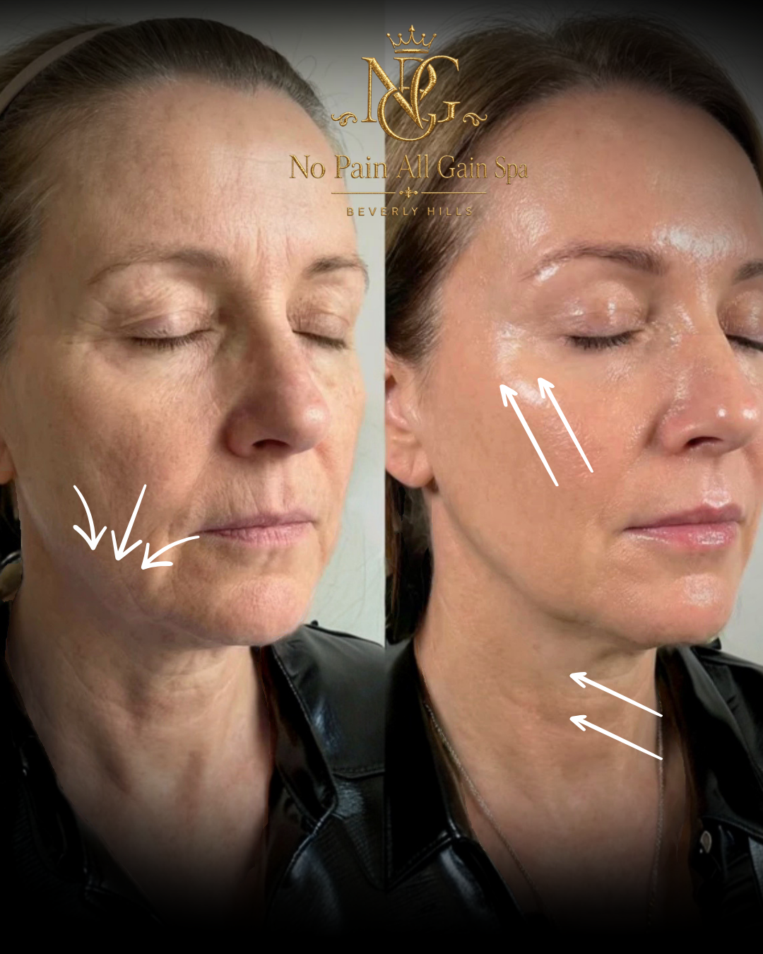 Before and after comparison of a woman showing skin improvements, with the before image on the left and the after image on the right, highlighting facial skin that appears smoother and more hydrated in the after photo, with white arrows pointing to s