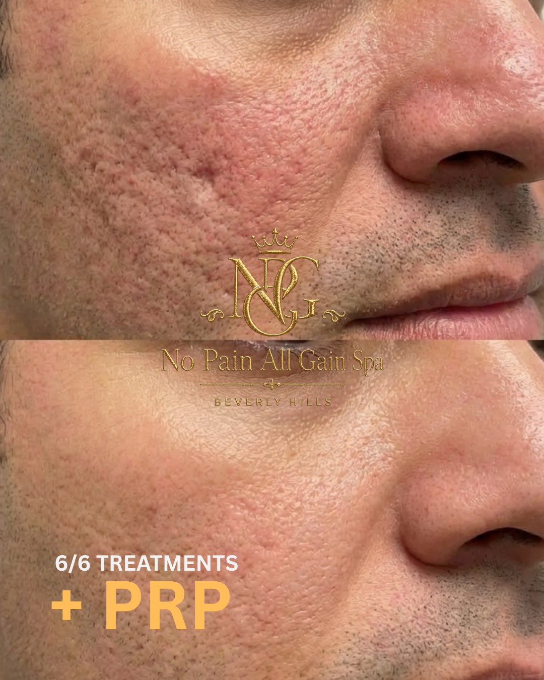 Side-by-side before and after images showing skin improvement, with the after image displaying smoother, clearer skin. Text overlay indicates six treatments and PRP at No Pain All Gain Spa in Beverly Hills.