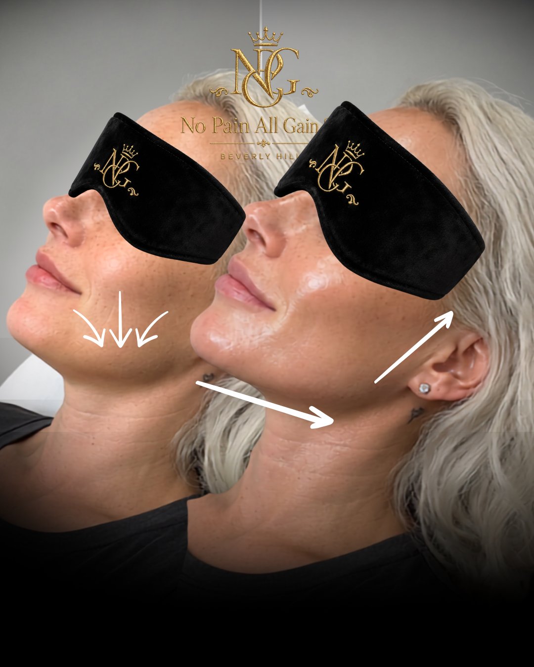 Side-by-side images of a woman before and after a facial treatment, highlighting a jawline lift with arrows pointing downward on the left and upward on the right. The woman wears black eye masks with gold logo and has platinum blonde hair and earring