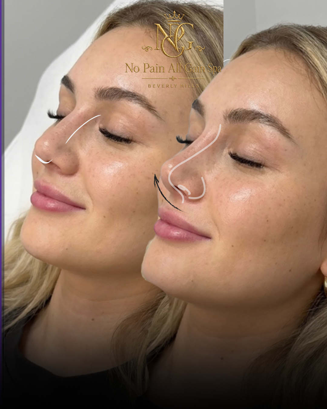 Side-by-side comparison of a woman's profile before and after a non-invasive nose reshaping procedure at No Pain All Gain Spa, Beverly Hills. The before image shows the nose with a slight bump, while the after image shows a smooth, refined nose shape
