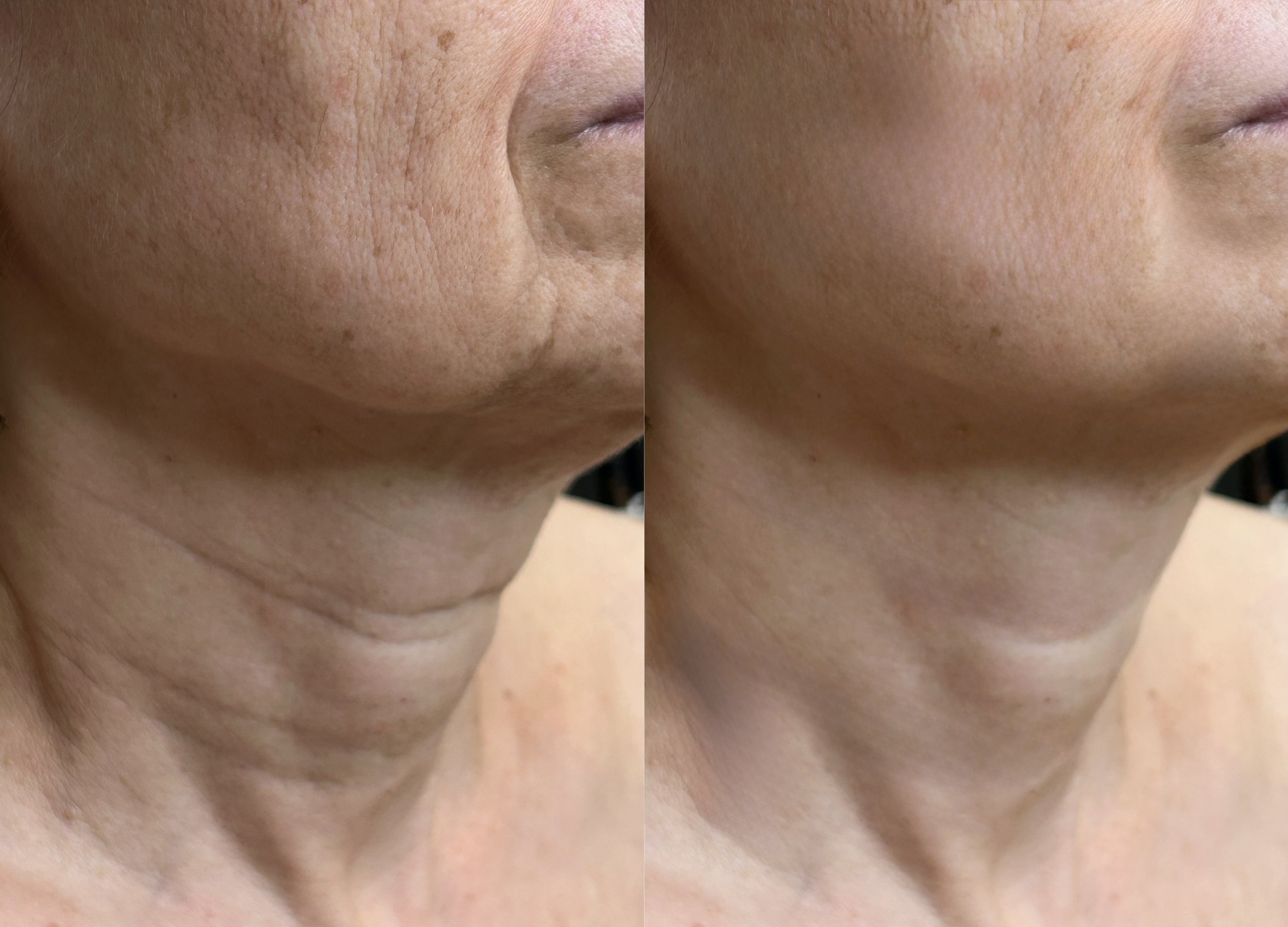SKIN RF MICRONEEDLING BEVERLYY HILLS 