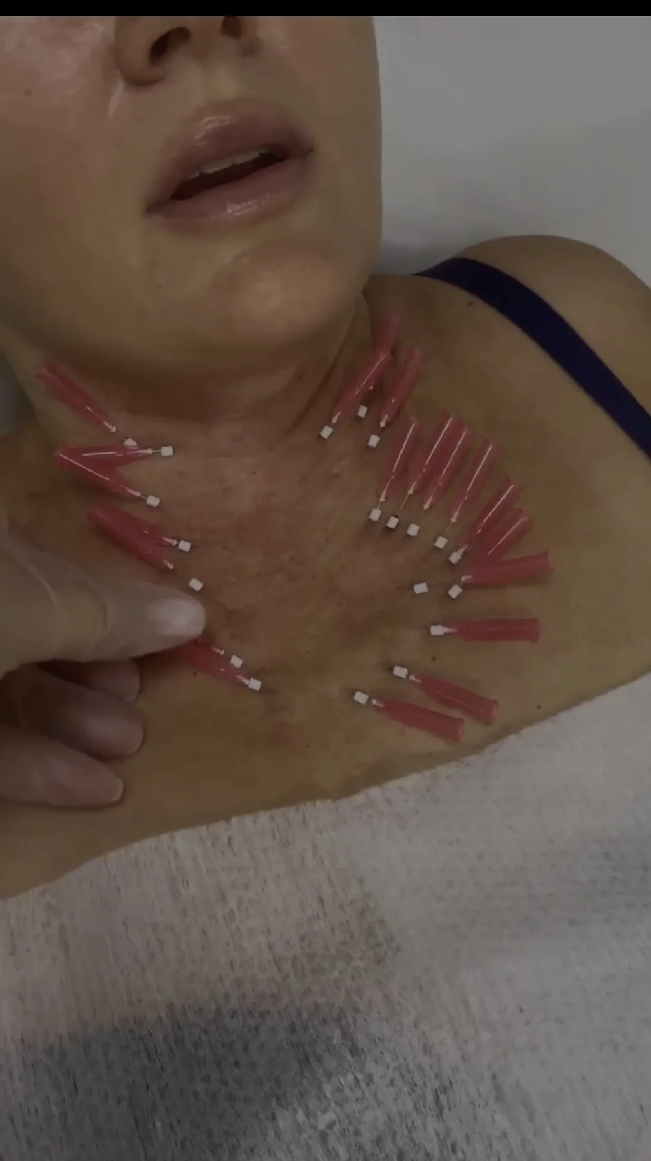 A woman receiving a cosmetic treatment with multiple pink and white skincare or acupuncture needles inserted into her chest and neck area.