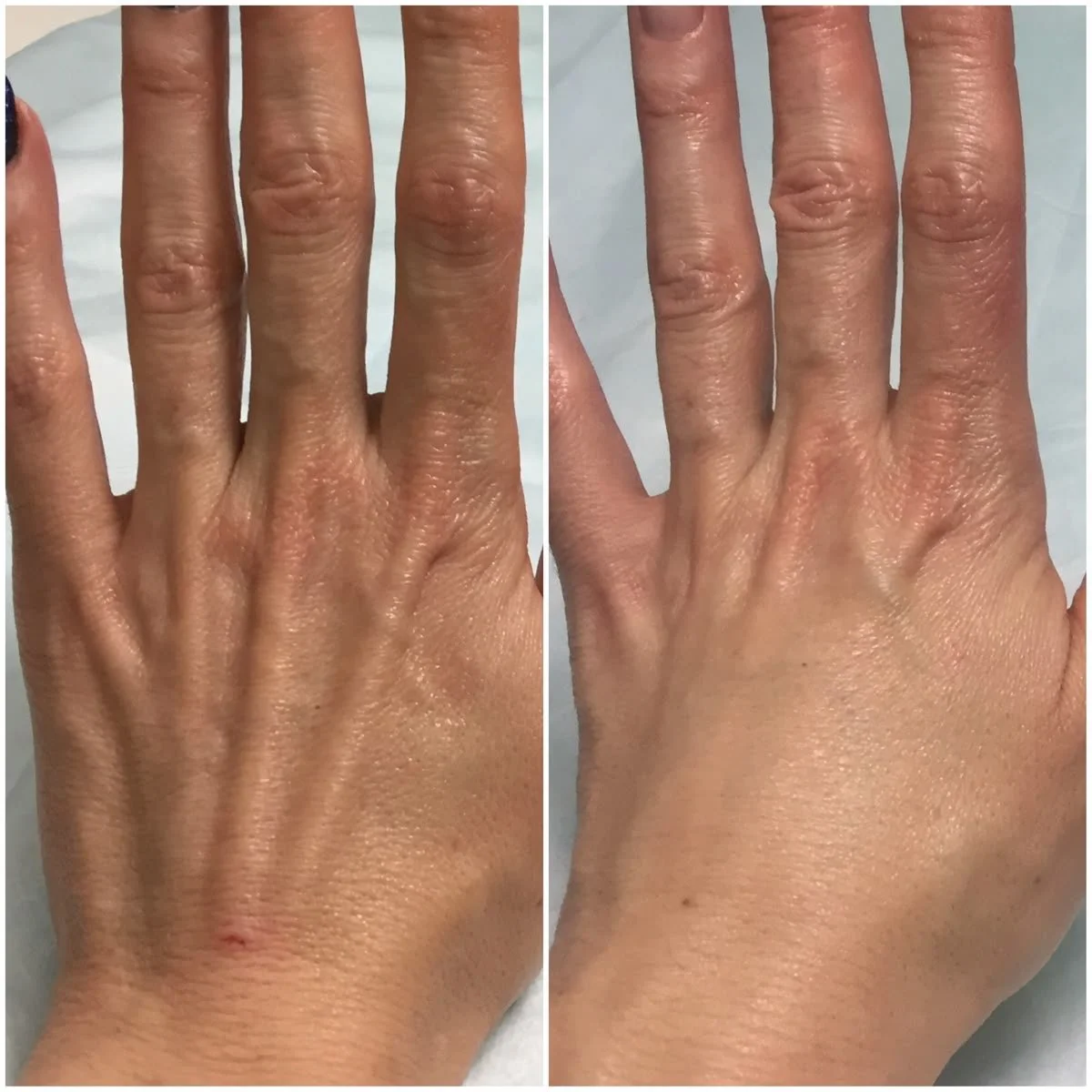 Comparison of a hand before and after skincare treatment showing improved skin texture and reduced dryness on the fingers and back of the hand.
