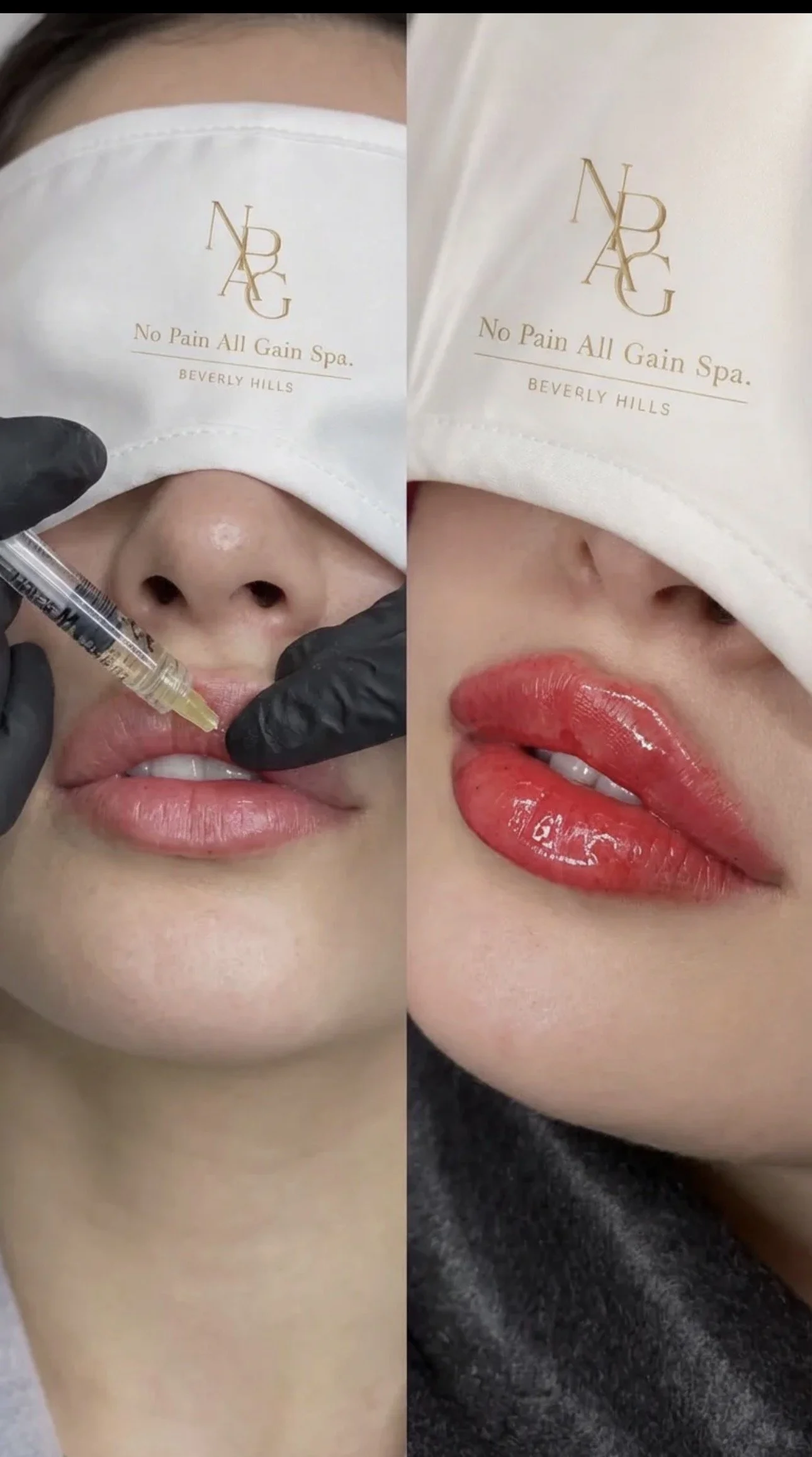 Before and after photos of a person receiving lip injection treatment and then with glossy red lipstick applied.