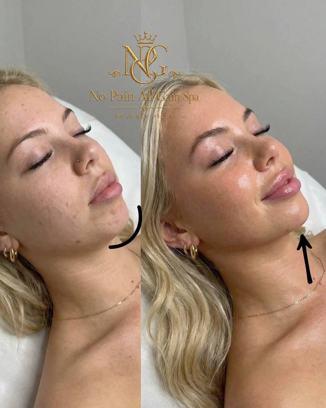 Side-by-side comparison of a woman's face before and after a skincare treatment at No Pain All Gain Spa in Beverly Hills. The left side shows her with a natural appearance, and the right side shows her with smoother, glowing skin.