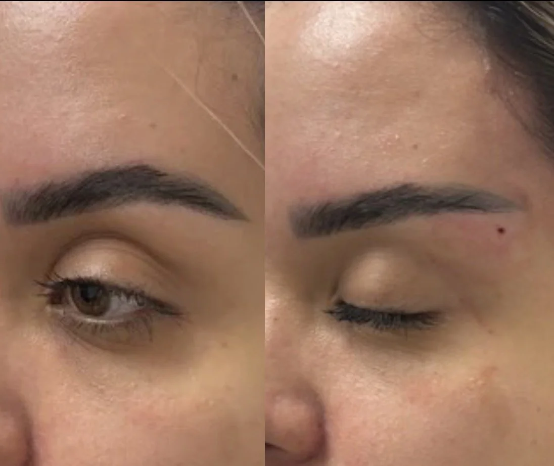 PDO THREAD BROW LIFT BEVERLY HILLS