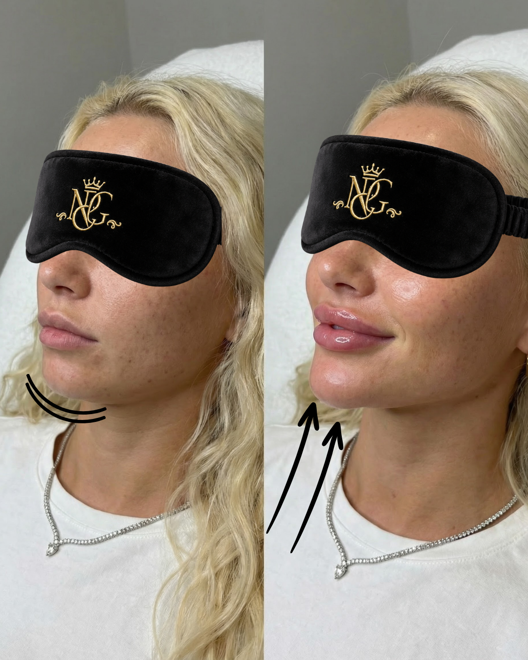 Comparison of a woman's face before and after lip enhancement; on the left, her face appears natural with minimal makeup, and on the right, her lips are fuller and glossy. She wears a black sleep mask with gold embroidery and a silver necklace.