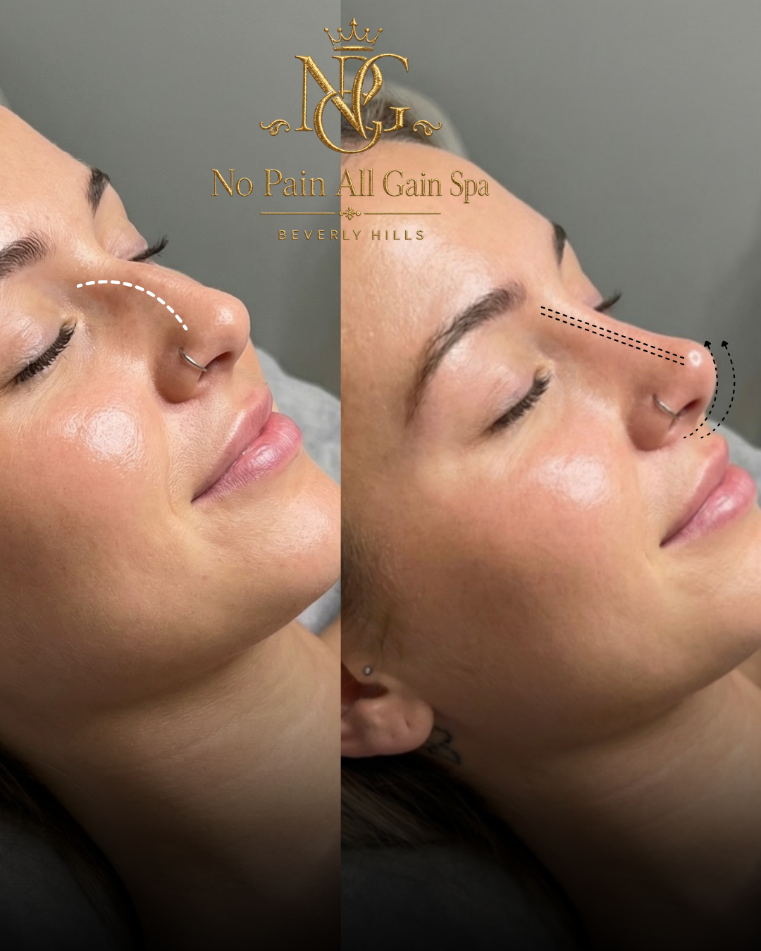 Side-by-side comparison of a woman before and after a non-invasive nose enhancement procedure at No Pain All Gain Spa in Beverly Hills, showing the nose shape and profile improvement.