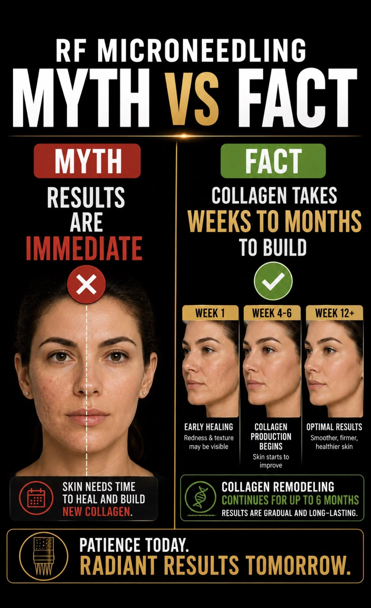 Comparison of skin healing process showing before and after results of RF microneedling treatment. Features a woman's face divided into sections: redness and texture on the left, gradual improvement with collagen production in the middle, and smooth, healthy skin on the right. The infographic highlights the myth versus fact of collagen healing timelines, emphasizing that collagen remodeling continues up to six months and results are gradual and long-lasting.