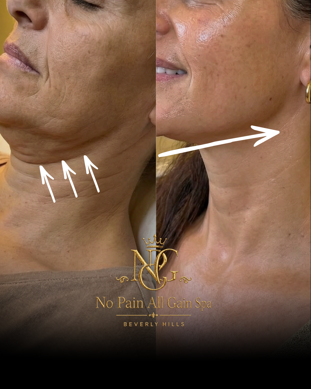 Before and after comparison of a woman's neck and jawline showing improvement in skin texture and firmness, with arrows pointing to the treated area and a promotional logo for No Pain All Gain Spa in Beverly Hills.