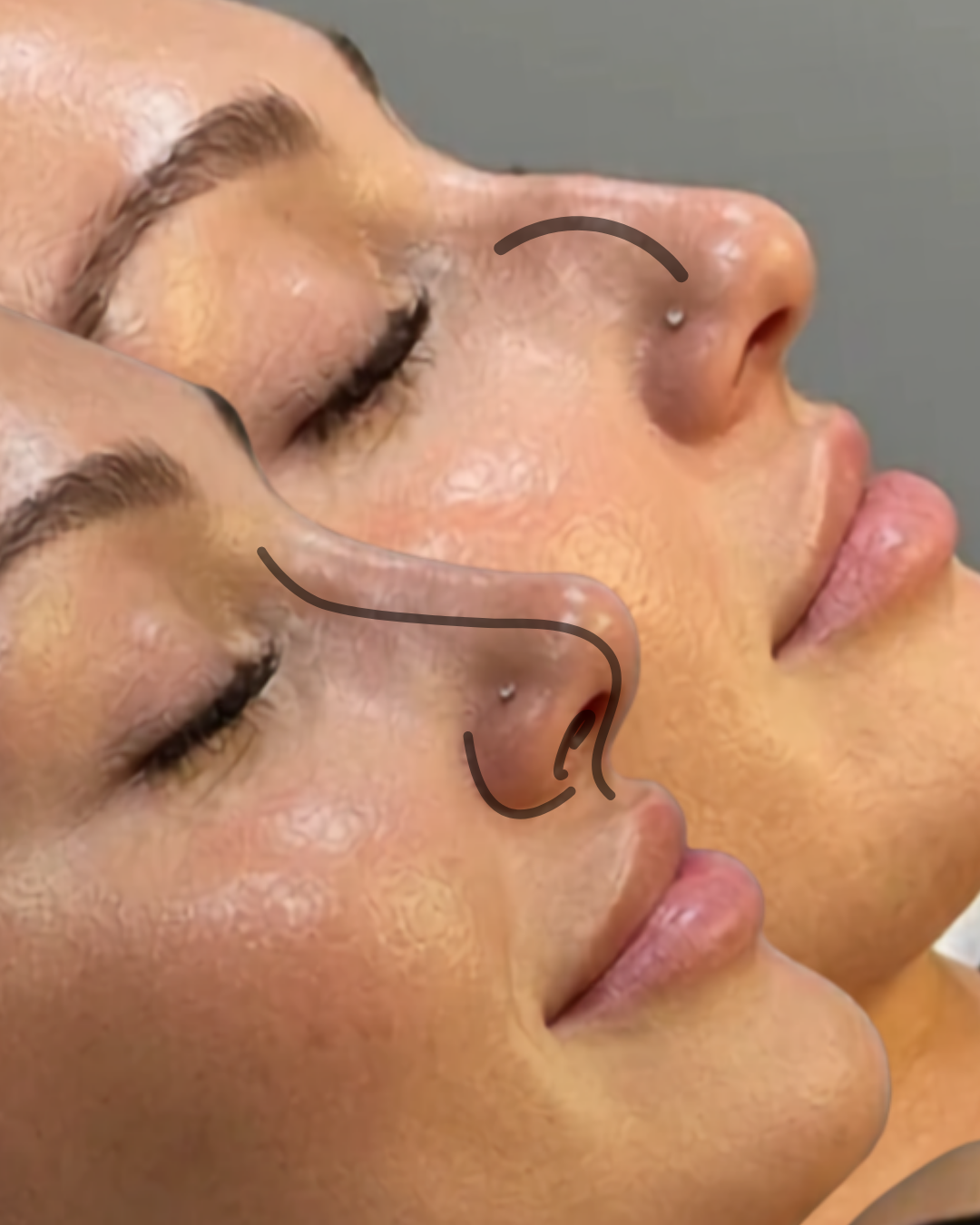 Close-up side profile of two women with their eyes closed, showcasing skin and facial features, with a black line illustrating the nose contour.
