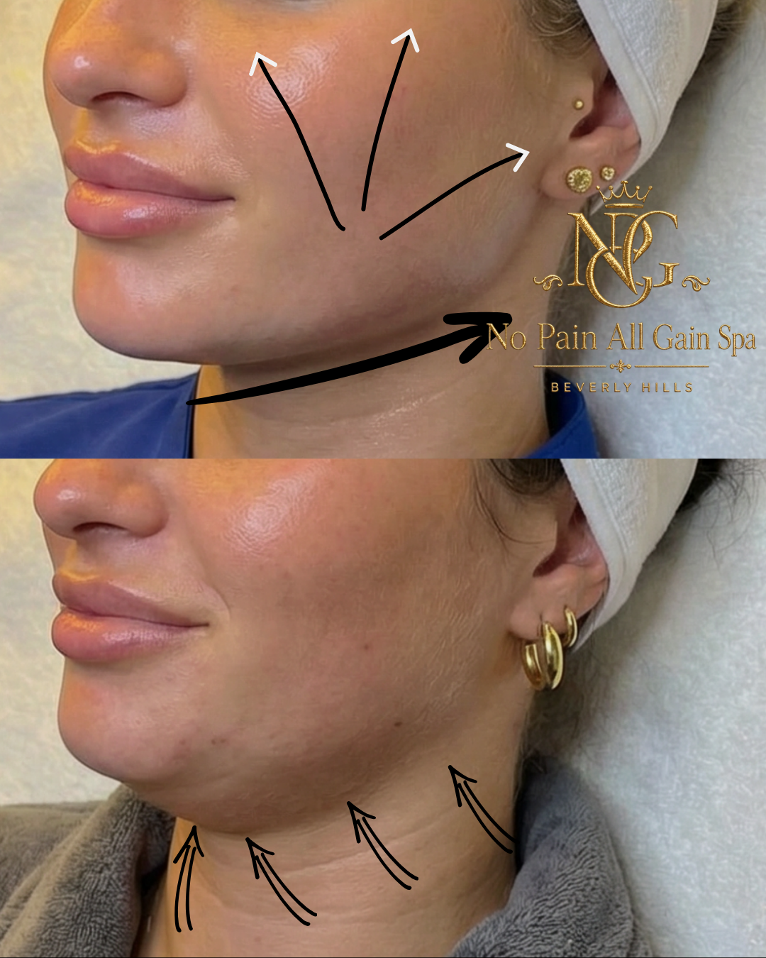 Before and after images of a woman's face showing skin improvements, with arrows pointing to cheek and neck areas, promoting a spa treatment by No Pain All Gain Spa in Beverly Hills.