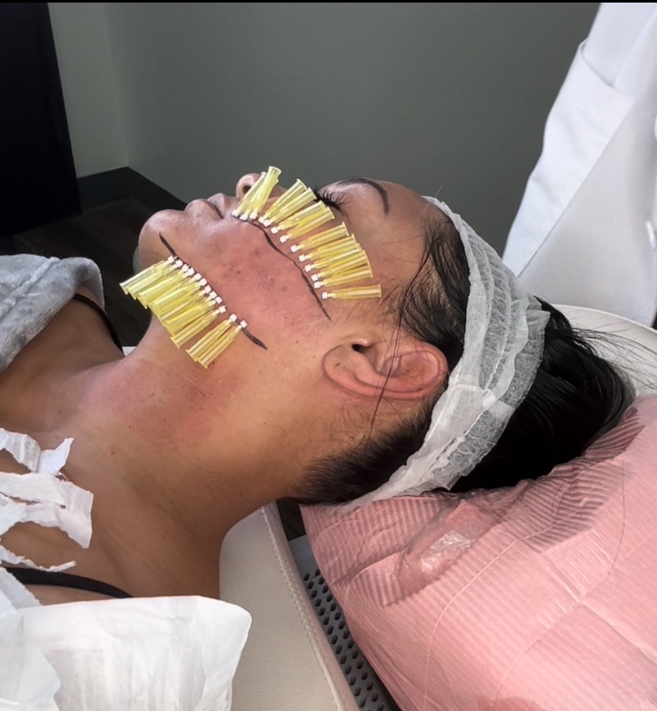 A person lying on a medical bed with protective tape on their face, undergoing a cosmetic or dermatological procedure, wearing a headband and surrounded by medical supplies.