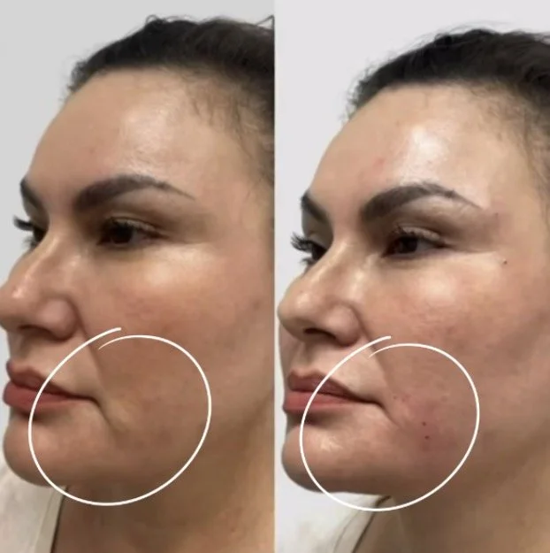 Side-by-side comparison of a woman's face before and after a skincare treatment showing improved skin texture and reduced blemishes, with circles highlighting the chin area.