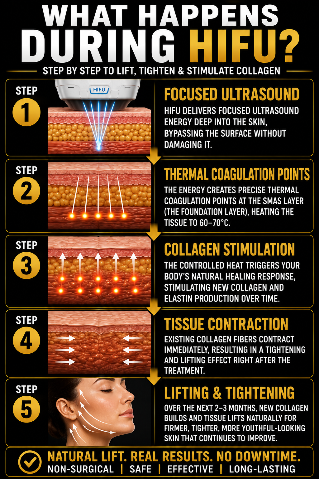 An infographic explaining what happens during HIFU skin treatment, including five steps: focused ultrasound, thermal coagulation points, collagen stimulation, tissue contraction, and lifting and tightening.