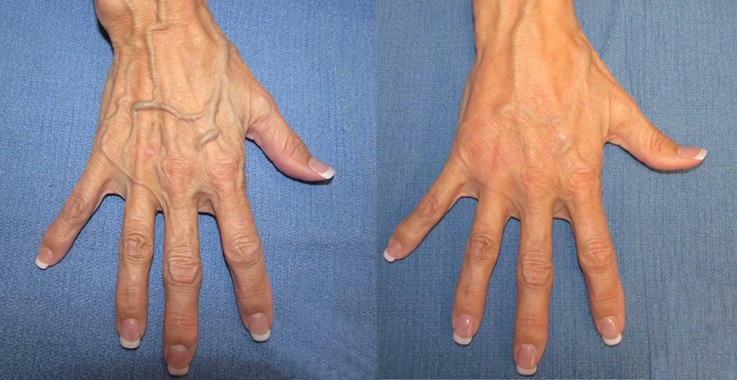 Comparison of a hand before and after skin treatment showing reduced wrinkles and improved skin texture.