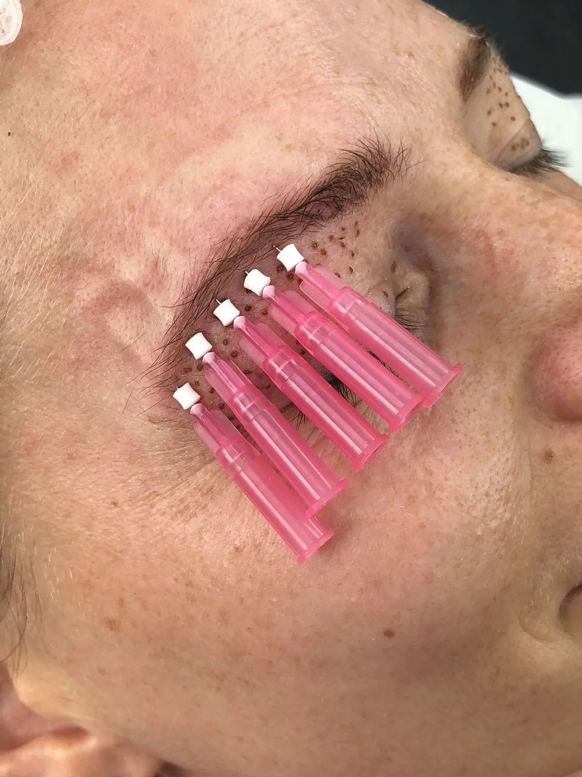 Close-up of a person's face with pink injection needles placed along the eyelid area for a cosmetic procedure.