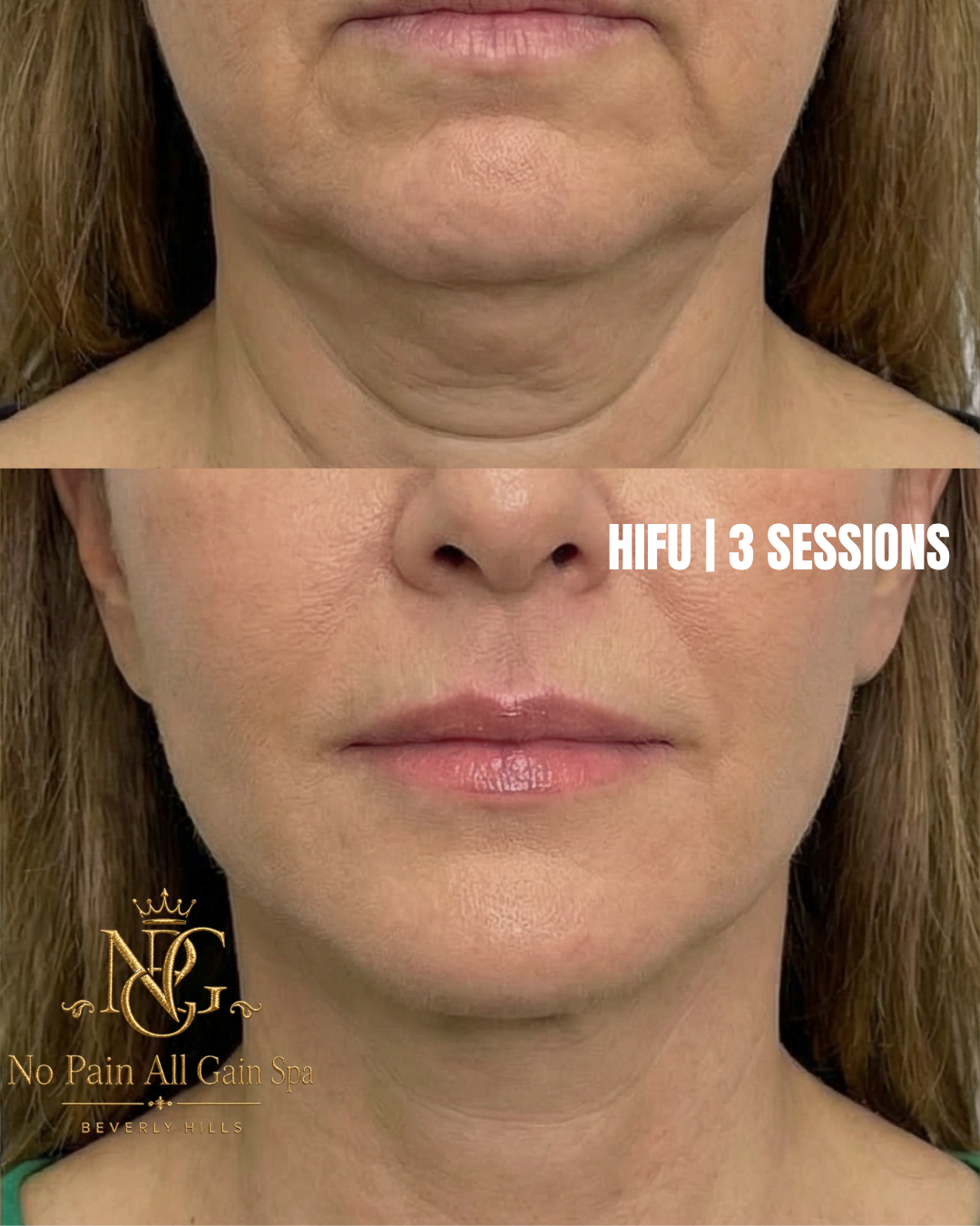 Before and after images of a woman's chin and lips showing facial improvements after 3 HIFU sessions, with No Pain All Gain Spa logo.